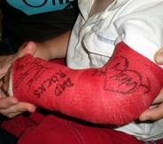 casts
